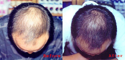 best home remedy for regrowing hair